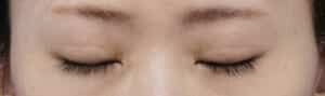 全切開症例①閉眼