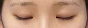 埋没法症例①閉眼