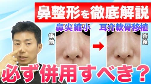 【鼻整形】鼻尖縮小と耳介軟骨移植は必ず併用すべきかについて解説