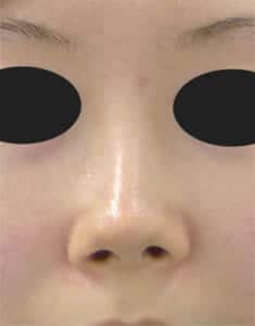 鼻中隔延長 正面 術前