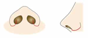 小鼻縮小（内側法＋外側法）の切開線イラスト