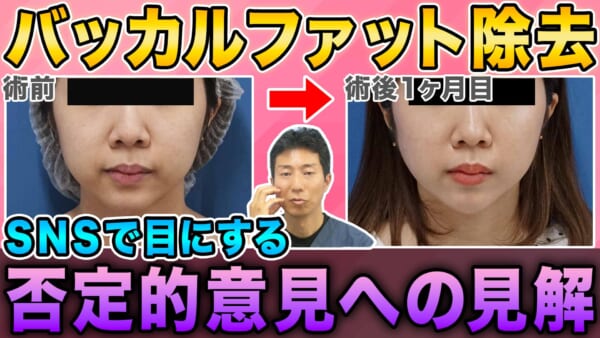 SNSで目にする、バッカルファット除去に対する否定的な意見について思うこと　