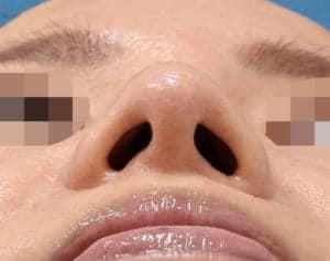 鼻尖縮小と小鼻縮小の併用 手術前下から3か月後