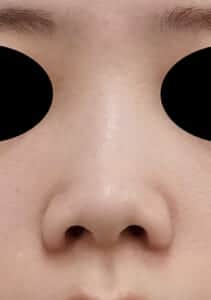 鼻尖縮小+軟骨移植 正面 術前