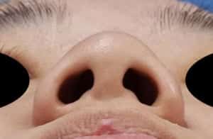 1 鼻尖縮小+軟骨移植+ストラット、鼻翼縮小(内+外法)下から手術前