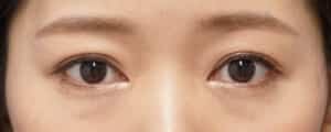 症例写真④3か月後
