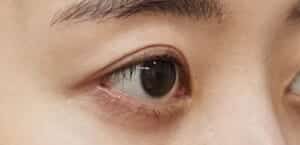 症例写真③右斜め3ヶ月後