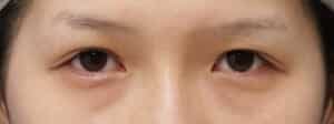 症例写真⑥手術前