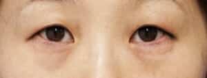 下眼瞼下制、目の下脂肪取り手術前