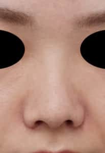 1 鼻尖縮小+軟骨移植+ストラット、鼻翼縮小(内+外法)正面3か月後