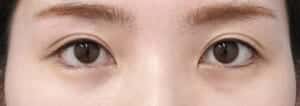 下眼瞼下制、目尻切開6か月後