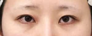 眉下切開　手術前