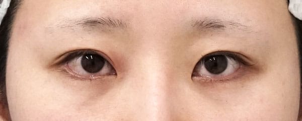 眉下切開　１ヶ月後のBefore写真