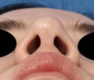 ④術後 下から