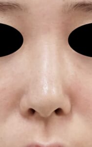鼻尖縮小+耳介軟骨移植 正面 術前