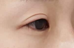 症例写真⑤右目斜め術前