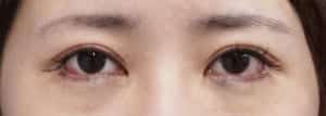 下眼瞼下制手術直後