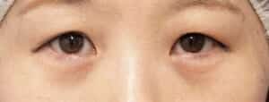 下眼瞼下制、目の下脂肪取り1週間後