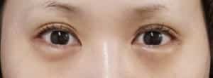 下眼瞼下制手術前