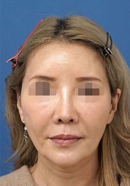 額ヒアルロン酸(ボリューマ) 2週間後 正面のAfterの写真
