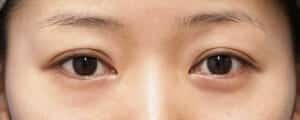 症例写真④手術前