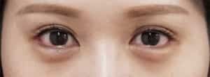 下眼瞼下制1か月後