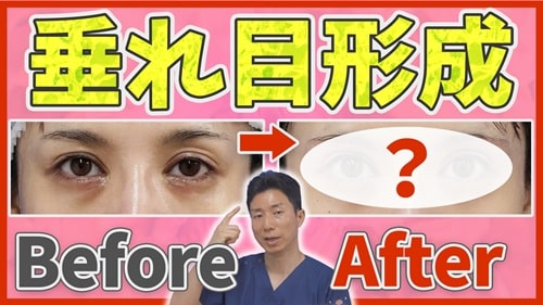 切開するたれ目形成のビフォーアフター