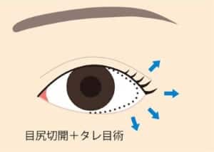 目尻切開＋タレ目