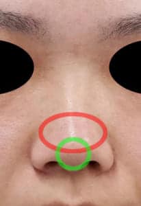 ②術前 正面丸