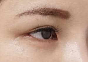 症例写真⑭右斜め2か月後