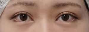 下眼瞼下制1か月後