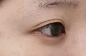 症例写真⑬右斜め術前