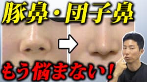 【鼻整形】豚鼻や団子鼻が解消！治し方を解説！【鼻中隔延長・耳介軟骨移植・鼻尖縮小】