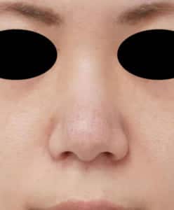 7-鼻翼縮小(flap外側) 3か月後 正面