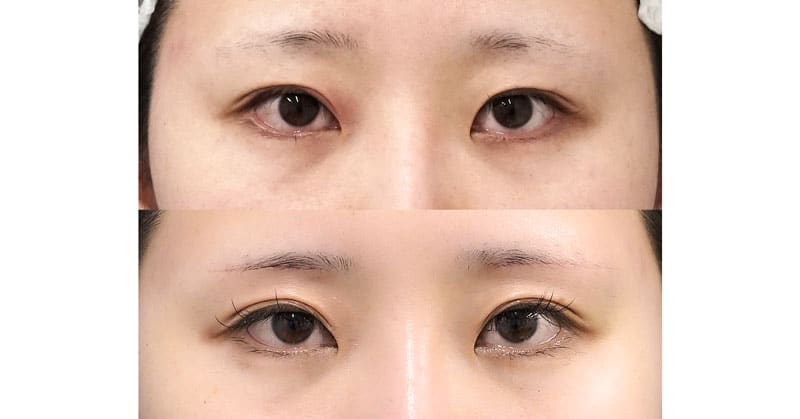 眉下切開で二重を自然に広くする｜眉下切開　１週間後