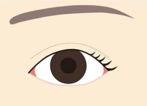 目尻切開結膜露出