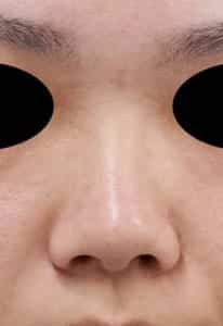 ②術前 正面
