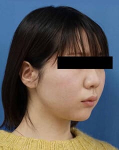 右ナナメ　15ヶ月後