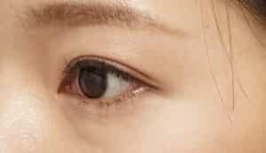 症例写真④左斜め3か月後