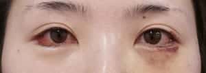 下眼瞼下制、目尻切開1週間後