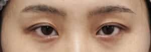 症例写真⑧手術前