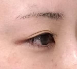 症例写真①右斜め術前
