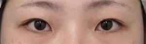 症例②全切開、目頭切開(Z形成)手術前