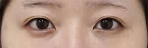 症例写真⑬手術前