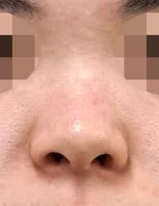 鼻尖縮小+軟骨移植、鼻孔縁延長 正面 手術前