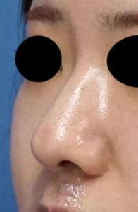 ③術後 左斜め