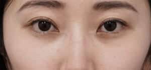 下眼瞼下制+目の下脂肪とり1か月後