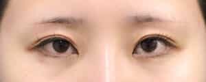 眉下切開　１ヶ月後