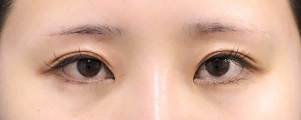 眉下切開　１ヶ月後のAfterの写真