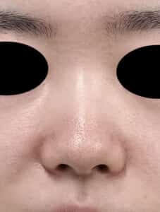鼻中隔延長 正面 術前